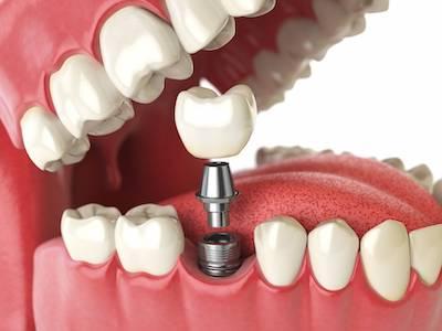 Dental Implant Illustration in Paoli, PA