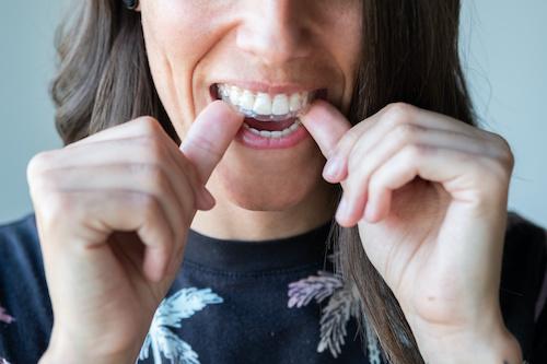 Invisalign Clear Braces in Paoli, PA